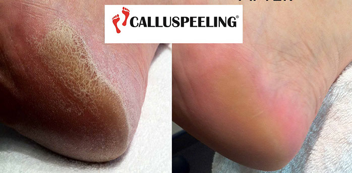 Calluspeeling – Ennen ja jälkeen